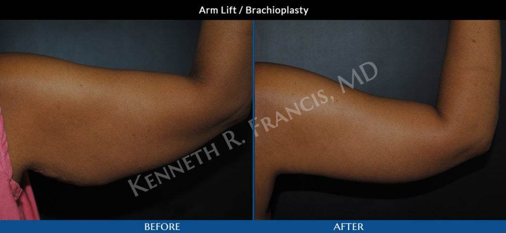 Arm Lift - Brachioplasty