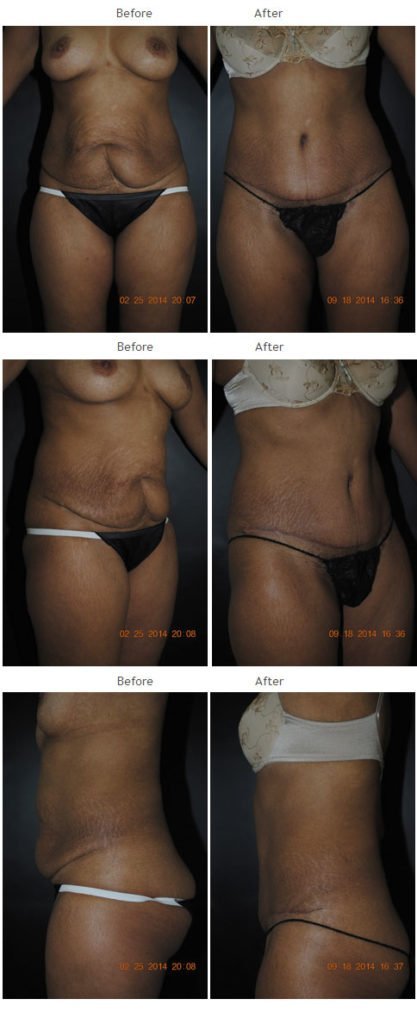 Case 1012 Tummy Tuck
