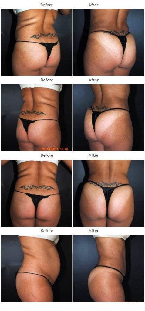 brazilian butt lift photos, brazilian butt lift pictures, brazilian butt lift before after