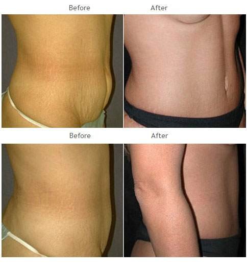 Case 1015 Tummy Tuck