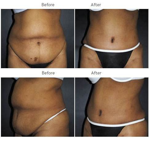 Case 1019 Tummy Tuck