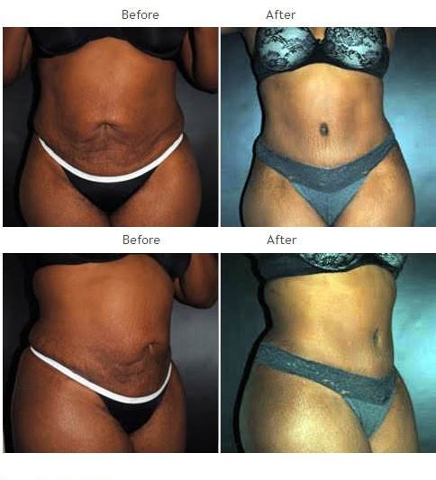 NYC tummy tuck