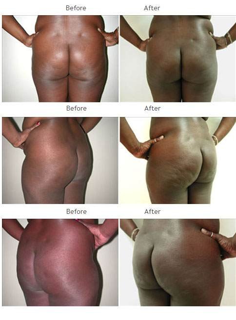 Brazilian Butt Lift NYC Case 1026