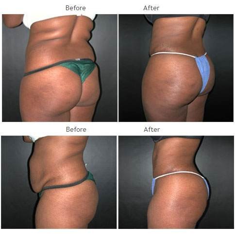 Brazilian Butt Lift NYC Case 1027