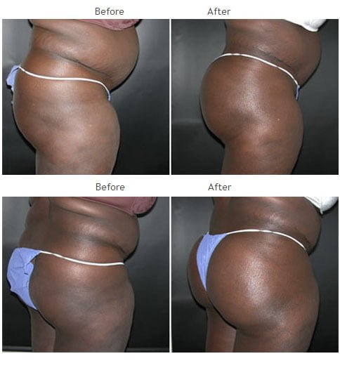 Brazilian Butt Lift NYC Case 1032