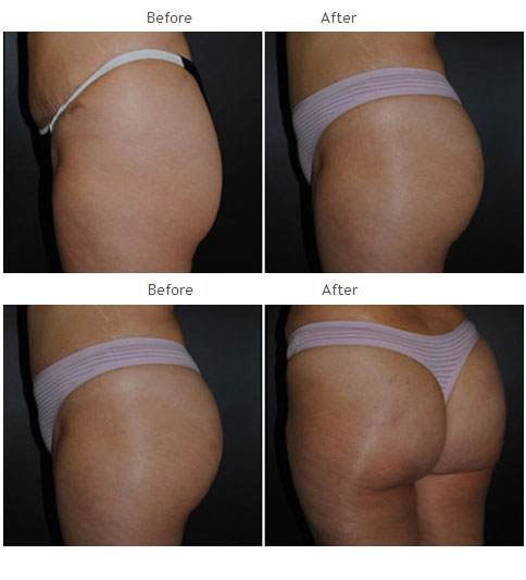 Brazilian Butt Lift NYC Case 1039