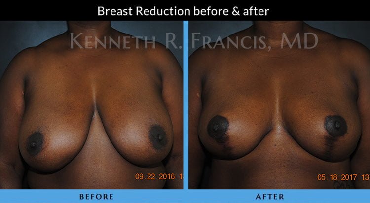 Breast Reduction NYC Case 1071