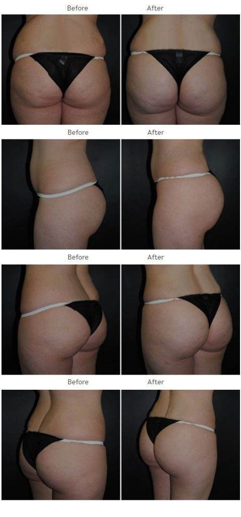 Brazilian butt lift before and after