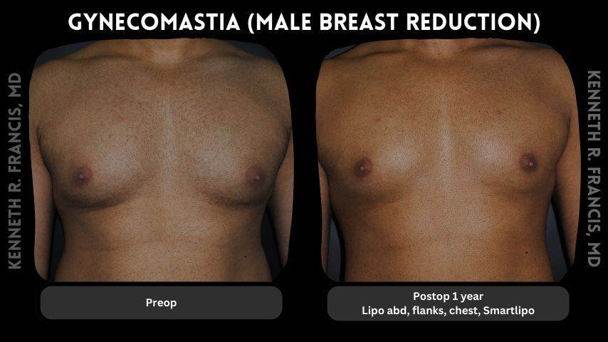 Gynecomastia before and after