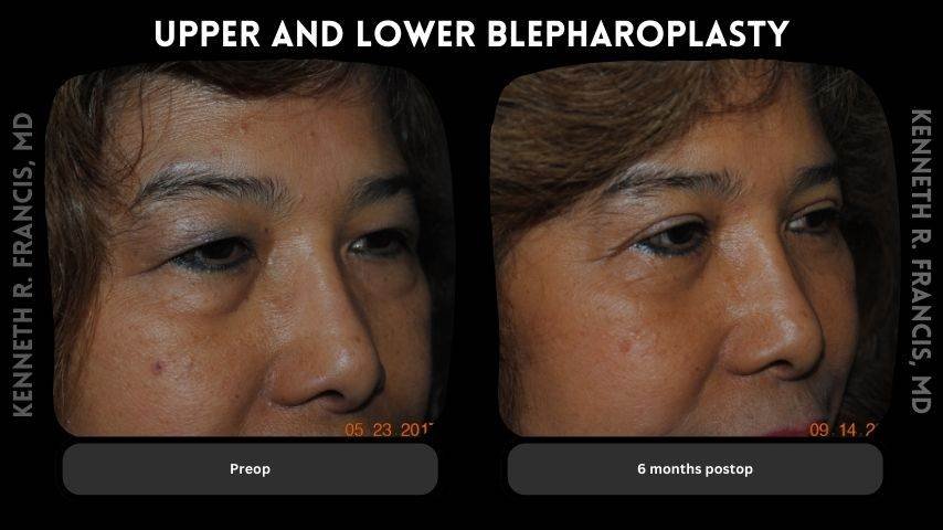 Upper and lower blepharoplasty