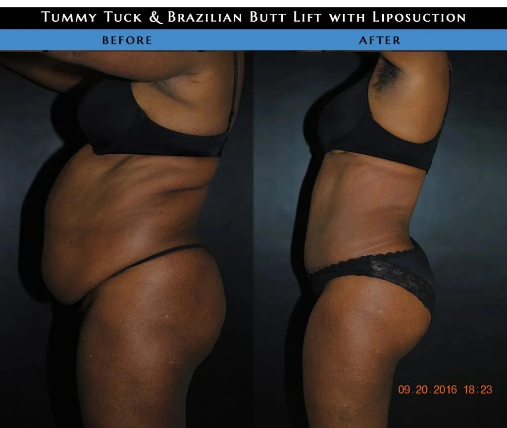 tummy tuck nyc