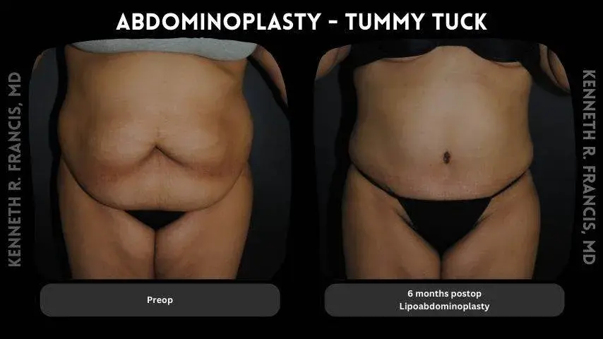 Tummy tuck nyc