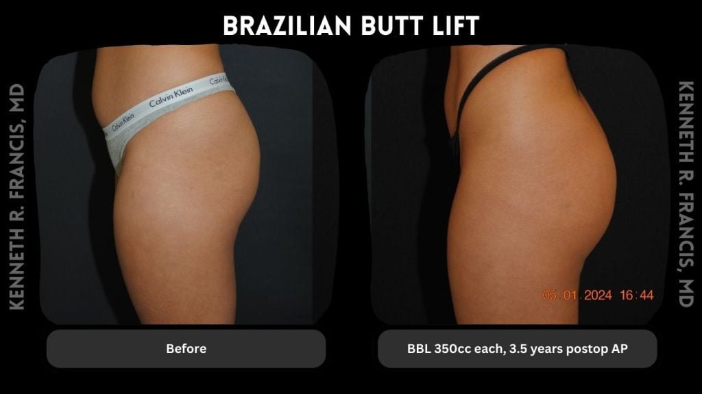 BBL 350cc each-3.5 years postop