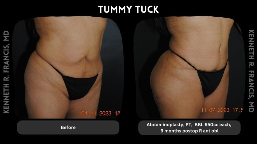 tummy tuck nyc before and after