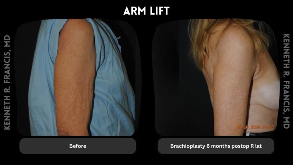 Arm Lift Brachioplasty 6 months postop R lat